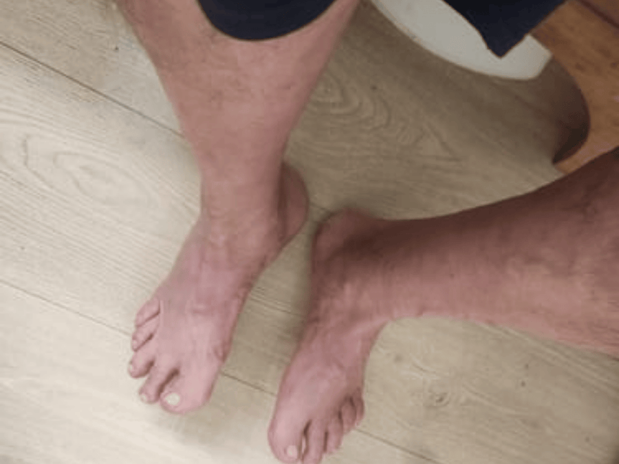 Sollievo enorme per il mio tallone dolorante
